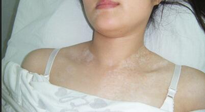 白癜风疾病能治疗好吗 青少年身上的白斑如何治疗