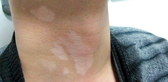 身上有白斑应该怎么办才能行 白癜风真的可以不用治疗吗