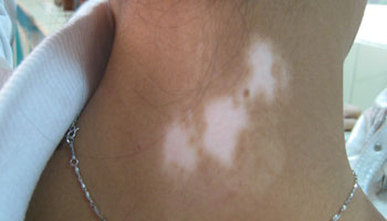 白癜风真的可以能治好吗 白癜风需要治疗多久才会痊愈呢