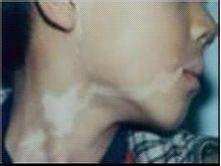 皮肤白癜风的治疗办法 患了白癜风怎么治疗呢