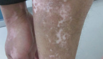 医治白癜风的方法有哪些 儿童白癜风怎么治