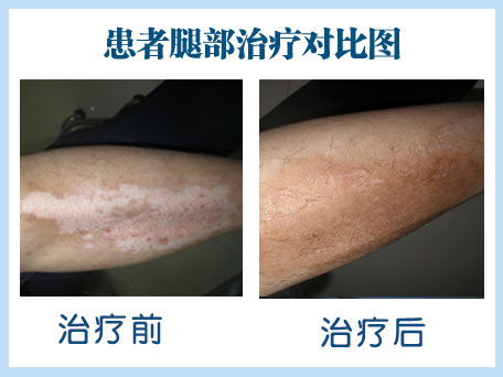 治疗白癜风哪种办法好 青少年白癜风冬季治疗注意事项