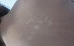 白癜风的治疗方法有哪些 青少年白癜风冬季治疗方法