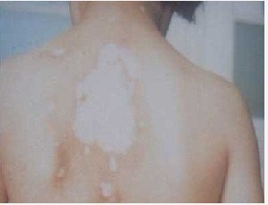 儿童白癜风能治好吗 白癜风怎么治疗更快恢复呢