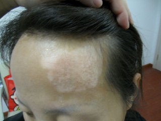 早期白癜风多久能治愈 17.jpg