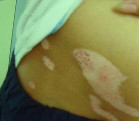 有白癜风怎么办 青少年腹部上的一块白癜风怎么治呢