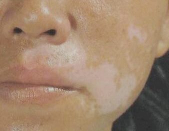 白癜风多久能够治愈 民间白癜风疗法有哪些