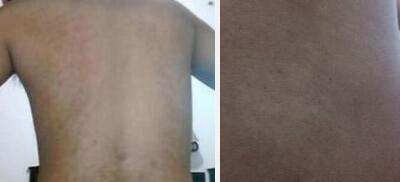 黄冈白癜风环亚高明 黄冈白癜风医院环亚用心