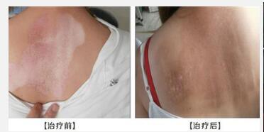 咸宁白癜风环亚精湛 黄冈白癜风医院环亚闻名