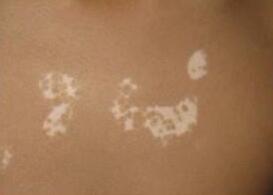 武汉白癜风可以用药物治疗吗 武汉白癜风治疗怎么治有效