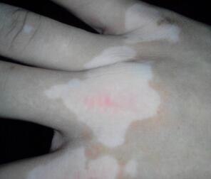 武汉青年人白癜风症状特点 武汉青少年早期白癜风症状