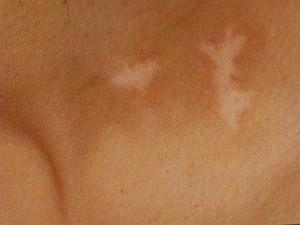 武汉白癜风的治疗注意事项都有哪些 武汉白癜风早期治疗优势有哪些