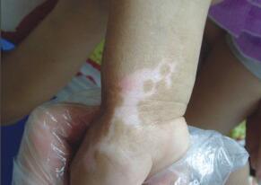 武汉儿童白癜风中医治疗方法有哪些 武汉请问白癜风可治疗吗