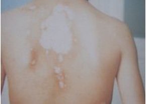 武汉白癜风分期治疗原则 武汉初期白癜风的治疗原则是什么