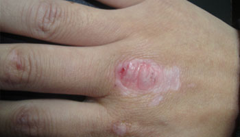 武汉青少年患白癜风该怎么防治 武汉患了白癜风涂药能够治得好吗