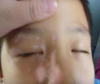 武汉白癜风医院介绍白癜风最新治疗方法有哪些 武汉少女白癜风药物治疗方法