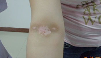 武汉白癜风怎么治疗最快恢复呢 武汉土方法治疗白癜风可以吗