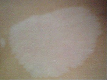 武汉治疗白癜风偏方有哪些 湖北白斑医院讲解女性白癜风如何治疗更好