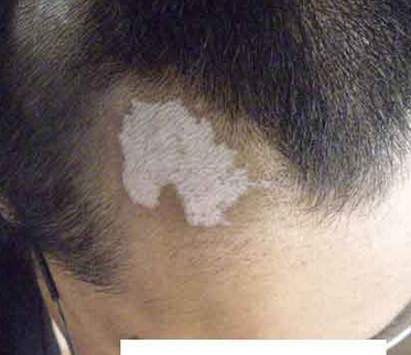 武汉白癜风怎么治疗可以有效防止扩散 武汉环亚白癜风医院讲解治疗白癜风需要注意什么