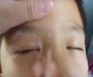 武汉白斑医院分析白癜风可以怎样治疗效果好 武汉白癜风医院提示治疗白癜风有哪些是需要注意的