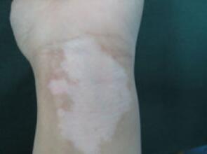 武汉白癜风在治疗过程中需要注意些什么 武汉白癜风积极治疗很关键