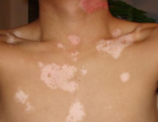 小儿白癜风的治疗时注意什么? 白癜风这种疾病怎样治疗好