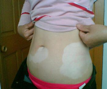 武汉白斑医院教你女性早期白癜风要如何治疗呢 武汉白斑医院分析白癜风初期除了用药还怎么治有效果