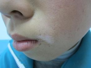 白癜风扩散有什么方法能控制住吗?武汉治白癜风哪个医院最好 白癜风到夏天变得很大怎么治?武汉治白癜风哪家最好