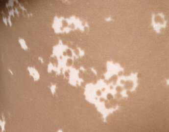 武汉白癜风治疗要关注的有哪些 武汉治疗白癜风注意哪些细节较好