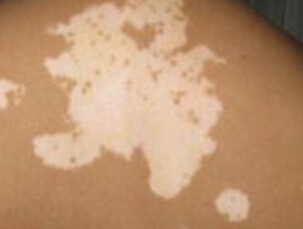 武汉初期白癜风如何治效果好 武汉治疗白癜风能够使用偏方吗