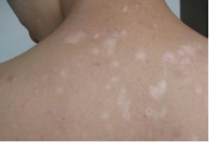 武汉偏方怎么治疗白癜风 武汉得了白癜风要怎么治