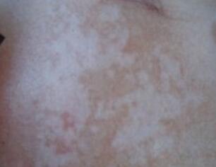 武汉白癜风患者治疗最少需要多长时间 武汉关于白癜风的症状如何治疗