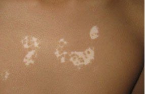 武汉哪个医院治白斑比较好?患白癜风的人越来越多的原因是什么 武汉哪家医院治白斑好?在日常生活中引发白癜风的因素有哪些