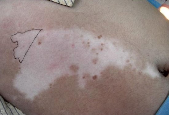 武汉专业治疗白癜风的医院?白癜风主要发病原因 武汉治疗白癜风最好医院?白癜风的诱因都有哪些