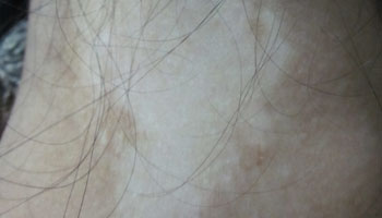 武汉治白斑病的医院?白癜风发病的直接原因是什么 武汉有没有白斑病医院?面部白癜风的发病诱因有哪些