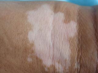 人ưװߵרҽԺưôƤ