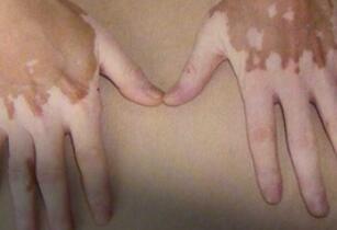 武汉治白癜风最好医院?儿童白癜风的病因有哪些 武汉治白癜风好的医院?白癜风病因和治疗