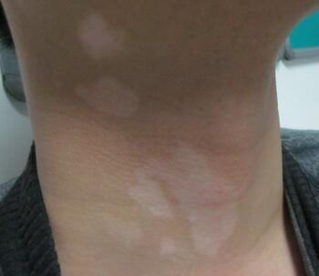 武汉白癜风医院在哪里?怎样做才能远离白癜风 武汉有治白癜风的医院吗?夏季应如何预防白癜风呢