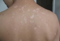 武汉看白癜风的正规医院?白癜风的诱发因素是什么 武汉有治疗白癜风的医院吗?白癜风的原因是什么呢