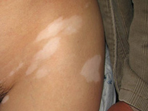 武汉哪家医院治白癜风好?哪些原因容易诱发白癜风 武汉治白癜风?白癜风频发的原因有哪些